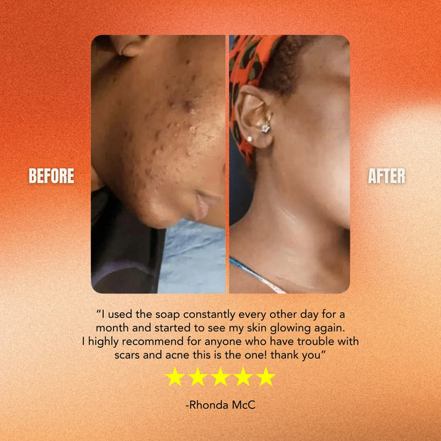 Brightening Turmeric & Kojic Acid Soap